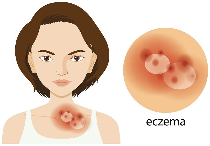 Eczema Causes and symptoms