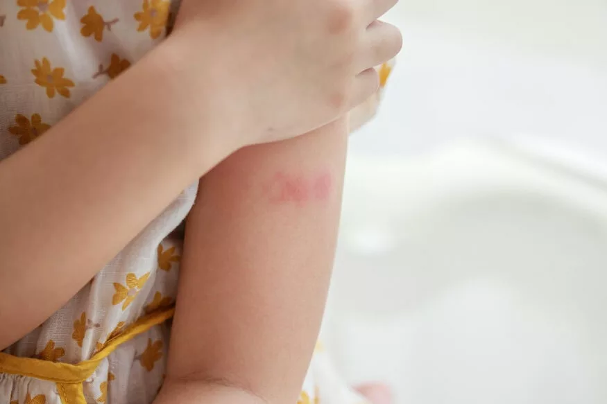 infant skin rash