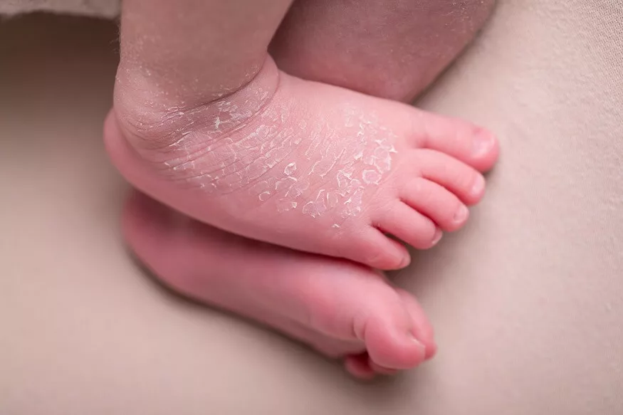 newborn skin peeling